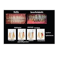 Periodontal Disease Staging Poster Health Poster Dental Clinic Poster Canvas Wall Art Poster Print Picture Paintings for Living Room Bedroom Office Decoration, Canvas Poster Art Gift for Family Friend