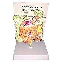 Gut Anatomy Model, Human Large Intestine Pathology Model, Intestinal Lesion Cecal Rectum Duodenal Ulcer Anatomical Medical Teaching Tools