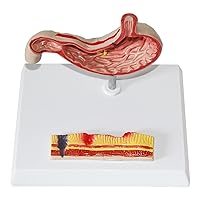 Human Stomach Anatomy Model, Gastric Lesion Model, Gastric Ulcer and Gastric Perforation Model, for Medical Study Teaching of Human Organs