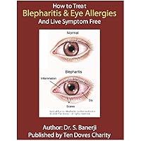 How to treat Blepharitis and Eye Allergies and live symptom free: Blepharitis Guide written by a Doctor.