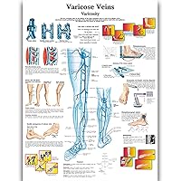 Varicose Veins Anatomy Posters for Walls Nursing Students Educational Anatomical Poster Chart Waterproof Canvas Medicine Disease Map for Doctor Enthusiasts Kid's Enlightenment Education (Varicose Veins, 20x30inches)
