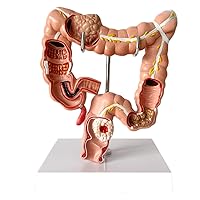 Teaching Model, Human Large Intestine Anatomical Model Visceral Lesion Model - Colon Pathology Model PVC Human Anatomical Anatomy Digestive System Studying Teaching Model Anatomy Biology
