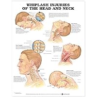 Whiplash Injuries of The Head and Neck Anatomical Chart