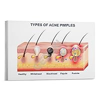 Different Types of Acne Posters Epidermal Dermal Structure Posters Beauty Salon Posters Canvas Painting Posters And Prints Wall Art Pictures for Living Room Bedroom Decor 20x30inch(50x75cm) Frame-sty