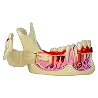 Dental Mandibular Decomposition Teeth Model Oral Caries and Root Cyst Demonstration Anatomical Model for Dentists Tool Teaching Education