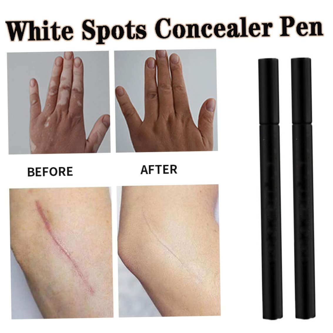 White Spots Concealer Pen Waterproof Long Lasting Vitiligo Scars Birthmarks Cover Pencil Natural Camouflage Makeup Pen Concealers & Correctors