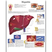 Hepatitis Science Anatomy Posters for Walls Medical Nursing Students Educational Anatomical Poster Chart Medicine Disease Map for Doctor Medical Enthusiasts Kid's Enlightenment Education Waterproof Canvas
