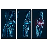 Thigh and Knee Joint Side View Poster Office Decor 3 Panel Contemporary Modern Artwork Disease, Pain, and Inflammation of the knee Joint Pictures Posters & Prints Framed Ready to Hang 60