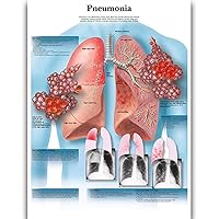 Pneumonia Science Anatomy Posters for Walls Medical Nursing Students Educational Anatomical Poster Chart Medicine Disease Map for Doctor Medical Enthusiasts Kid's Enlightenment Education Waterproof Canvas