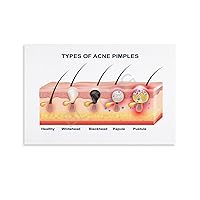 Beauty Salon Poster Types of Acne Pimples Poster Epidermis Dermis Structure Poster Canvas Painting Posters And Prints Wall Art Pictures for Living Room Bedroom Decor 12x18inch(30x45cm)