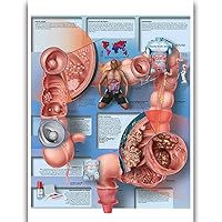Colon Cancer Anatomy Posters for Walls Nursing Students Educational Anatomical Poster Chart Waterproof Canvas Medicine Disease Map for Doctor Enthusiasts Kid's Enlightenment Education (Colon Cancer, 20x30inches)