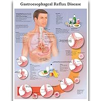 Gastroesophageal Reflux Science Anatomy Posters for Walls Medical Nursing Students Educational Anatomical Poster Chart Medicine Disease Map for Doctor Medical Enthusiasts Kid's Enlightenment Education Waterproof Canvas