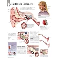 Middle Ear Infection chart: Wall Chart