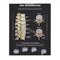 WENHUIMM Levels of Spinal Degeneration Chiropractors Spine Knowledge Guide Poster (3) Home Living Room Bedroom Decoration Gift Printing Art Poster Frame-style 16x20inch(40x50cm)