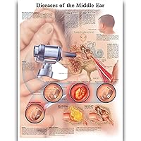 Diseases of Middle Ear Anatomy Posters for Walls Nursing Students Educational Anatomical Poster Chart Waterproof Canvas Medicine Disease Map for Doctor Enthusiasts Kid's Enlightenment Education (Diseases of Middle Ear, 20x30inches)