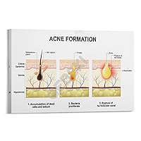 KMJBFE Beauty Salon Poster Acne Formation Type Poster Epidermal Structure Poster Canvas Painting Posters And Prints Wall Art Pictures for Living Room Bedroom Decor 16x24inch(40x60cm) Frame-style
