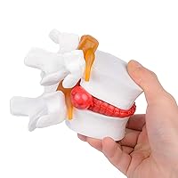 Human Anatomical Lumbar Disc Herniation Model 1:1.5Size Human Spine Model White Color