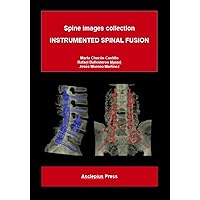 INSTRUMENTED SPINAL FUSION: Spine images collection INSTRUMENTED SPINAL FUSION: Spine images collection Kindle Paperback