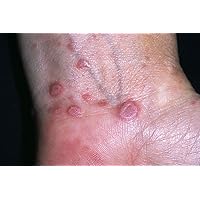 Skin Disease ( Lichen Planus ): By Dr.Naval Patel