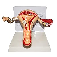 Human Pathological Uterus Ovary Model - Uterus-Ovary Model - Female Reproductive Organs Medical Lesion for Teaching Learning Tool