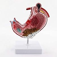 Stomach Anatomy Model, Human Pathological Stomach Model, Stomach Disease Demonstration Model, for Medical Teaching Display