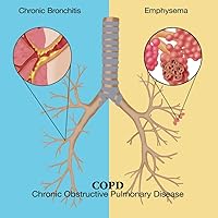 Chronic Obstructive Pulmonary Disease (COPD) Poster Print by Monica SchroederScience Source (18 x 18)