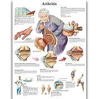 Arthritis Science Anatomy Posters for Walls Medical Nursing Students Educational Anatomical Poster Chart Medicine Disease Map for Doctor Medical Enthusiasts Kid's Enlightenment Education Waterproof Canvas