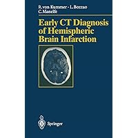 Early CT Diagnosis of Hemispheric Brain Infarction Early CT Diagnosis of Hemispheric Brain Infarction Paperback