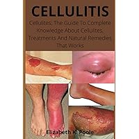 CELLULITIS: Cellulites; The Guide To Complete Knowledge About Cellulites, Treatments And Natural Remedies That Works CELLULITIS: Cellulites; The Guide To Complete Knowledge About Cellulites, Treatments And Natural Remedies That Works Paperback Kindle
