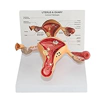 Pathology Uterus Ovary Model, Female Reproductive Organ Model Medical Teaching Uterus Model Human Anatomical Model for School Educational Demonstration Tool