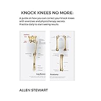 Knock Knees No More: A guide on how you can correct your knock knees with exercises and physiotherapy secrets: practice daily to start seeing results: Allen Stewart Knock Knees No More: A guide on how you can correct your knock knees with exercises and physiotherapy secrets: practice daily to start seeing results: Allen Stewart Paperback Kindle