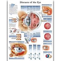 Diseases of the Eye Anatomy Posters for Walls Nursing Students Educational Anatomical Poster Chart Waterproof Canvas Medicine Disease Map for Doctor Enthusiasts Kid's Enlightenment Education (Diseases of the Eye, 20x30inches)