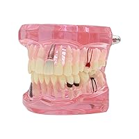 Teeth Model Teeth Typodonts Dental Implant Study Analysis Demonstration Teeth Model #2001 with Restoration Pink