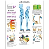 Osteoporosis Anatomy Posters for Walls Nursing Students Educational Anatomical Poster Chart Waterproof Canvas Medicine Disease Map for Doctor Enthusiasts Kid's Enlightenment Education (Osteoporosis, 20x30inches)