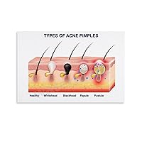 ABNUYHG Types of Acne Pimples Poster Beauty Salon Skin Management Posters Canvas Painting Wall Art Poster for Bedroom Living Room Decor 12x08inch(30x20cm)