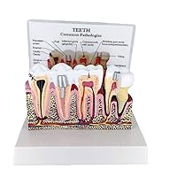 Teaching Model,Dental Model, Human Body Anatomy Replica of Teeth with Common Pathologies for Dentist Office Educational Tool, Anatomicals