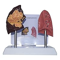 Human Respiratory System Model - Lung Anatomy Model - Smoking Lung and Normal Lung Comparison Anatomical Teaching Models for Science Classroom and Study