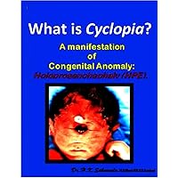What is Cyclopia ? A manifestation of Congenital Anomaly: Holoprosenchephaly (HPE). What is Cyclopia ? A manifestation of Congenital Anomaly: Holoprosenchephaly (HPE). Kindle