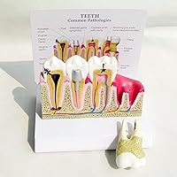 Removable Human Tooth Common Pathologies Anatomy Model with Illustrated Illustration, Teeth Disease Dental Model, for Medicine Teaching Demonstration