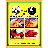What is Dupuytren's contracture? What is Dupuytren's contracture? Kindle