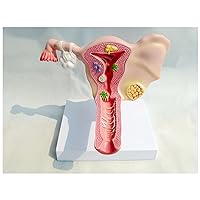 Human Pathological Uterus and Ovary Model, Female Reproductive Organ Model Uterus Anatomical Teaching Model for Doctor's Office and Classrooms, Medical Study Supplies