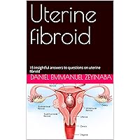 Uterine fibroid: 15 insightful answers to questions on uterine fibroid