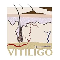 Vitiligo: A Step-By-Step Guide to Diagnosis, Treatment And Prophylaxis Vitiligo: A Step-By-Step Guide to Diagnosis, Treatment And Prophylaxis Kindle Paperback