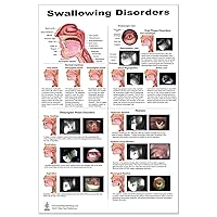 Swallow Disorders Anatomy Poster 24x36inch, Dysphagia Endoscopic View-oral Phase Disorders-nasal Regurgitation