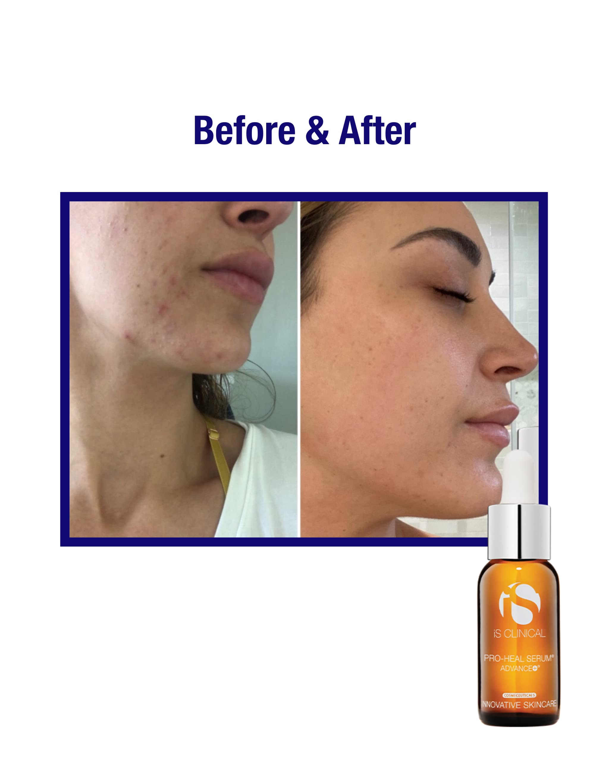 Pro-Heal Serum Advance+ antioxidant-rich serum containing vitamin C, E, and A for redness, rosacea, inflammation