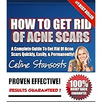 How To Get Rid Of Acne Scars! – The #1 Best Guide To Quickly & Easily Get Rid Of Acne Scars!