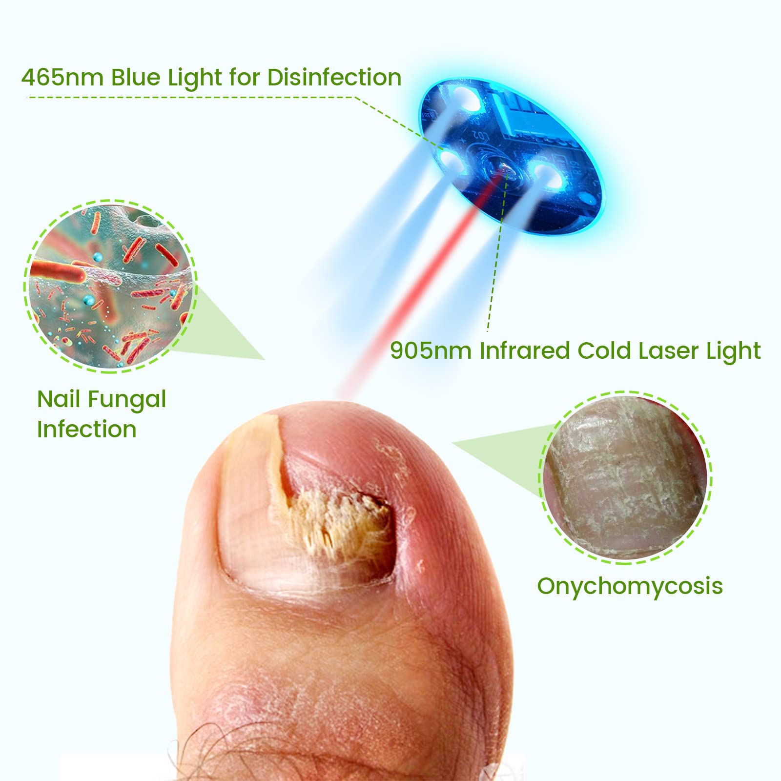 pinfriy Nail Fungus Cleaning Device Home Treatment for Toenail Fungus & Onychomycosis 905nm Infrared Light+ 470nm Blue Light