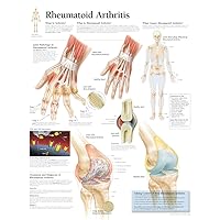 Rheumatoid Arthritis: Laminated Wall Chart
