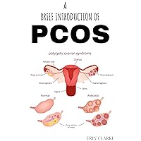 PCOS - A brief Introduction of Polycystic ovary syndrome