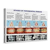 ABRAGO Stages of Periodontal Disease Dental Clinic Guide Poster Tooth Anatomy Poster (1) Home Living Room Bedroom Decoration Gift Printing Art Poster Frame-style 16x12inch40x30cm